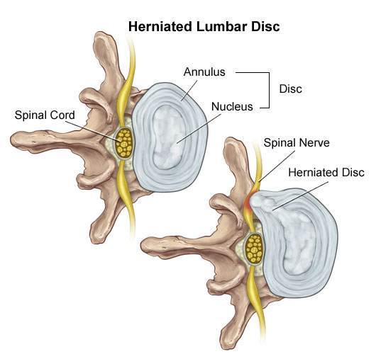 Lumbar Disc Herniation-Downtown Toronto Chiropractor