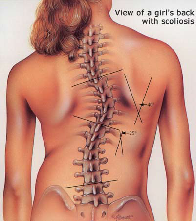 Kids' Scoliosis How to Check Your Child For Scoliosis-Toronto Downtown Chiropractor