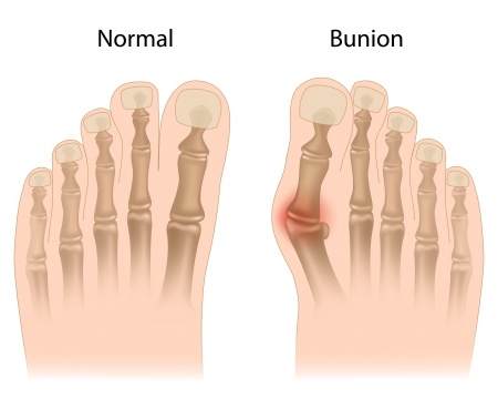 Keep the Bunion Surgeon Away With These Bunion Tips
