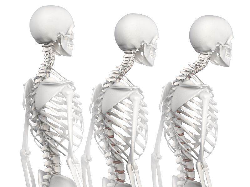 How To Improve Posture-Toronto Chiropractor