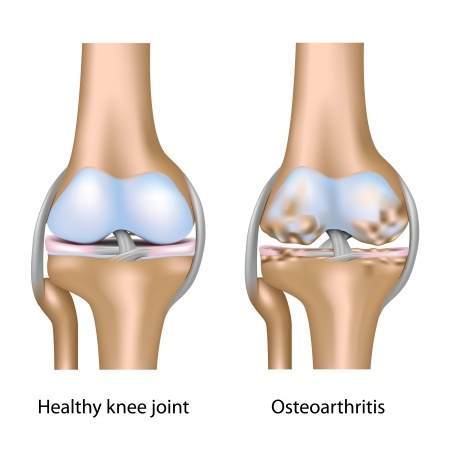 Knee Osteoarthritis? Surgery Injection or Neither|Toronto Downtown Chiropractor