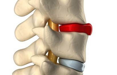 What's Worse—Bulging or Herniated Discs?