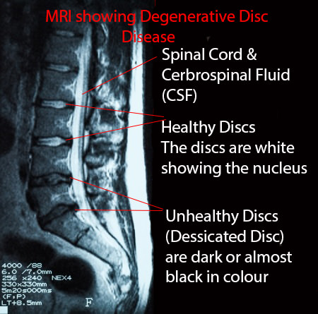 MRI of Degnerative Disc DiseaseMRI Showing The Lower Back With Healthy Disc Near The Top With The Bottom Four Being Narrowed, Darker in Color With Disc Bulges: Degenerative Disc Disease: Downtown Toronto Chiropractic