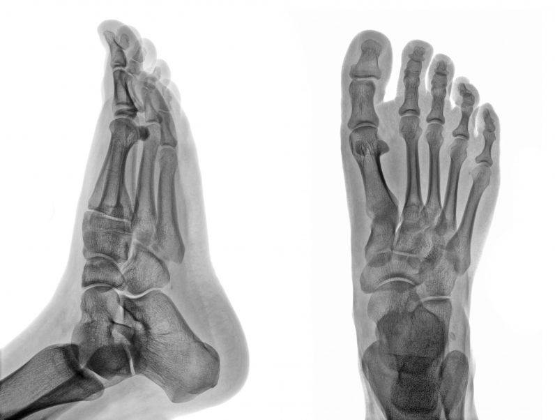 Cuboid Syndrome: Downtown Toronto Chiropractor Dr. Ken Nakamura