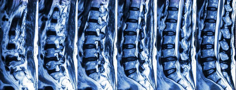 MRI of lumbar spine can reveal lumbar disc hernitions, spinal stensosis or other potential problems. Individualized exercises can be very helpful for lumbar disc hernitions.