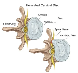 Herniated Cervical Disc: Learn what treatments are best: Downtown Toronto Chiropractor Dr. Ken Nakamura