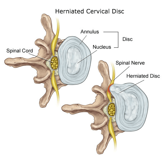 Herniated Cervical Disc: Learn what treatments are best: Downtown Toronto Chiropractor Dr. Ken Nakamura