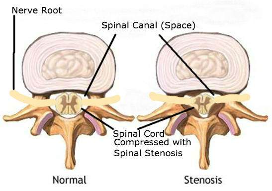 What is Spinal Stenosis? | Dr Ken Nakamura Downtown Toronto Chiropractor