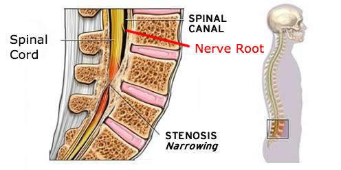 Spinal Stenosis showing spinal Canal| Dr Ken Nakamura Downtown Toronto Chiropractor