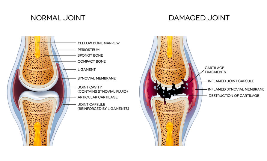Osteoarthritis: Damaged joint and healthy joint detailed diagram | Best Toronto Chiropractor Dr Ken Nakamura Downtown Toronto Chiropractor