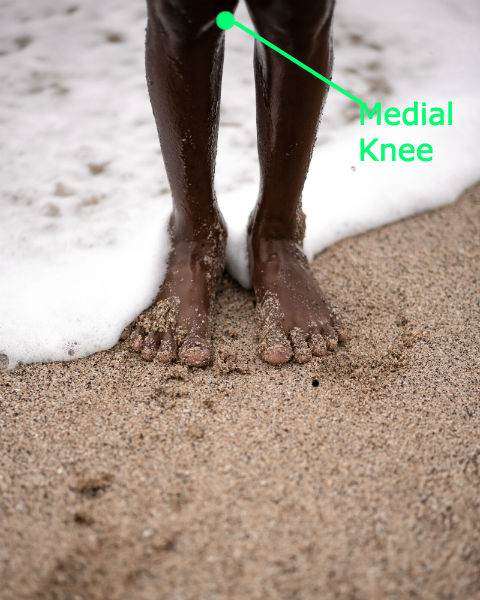 Plica Syndrome: Most often plica syndrome causes pain at the medial knee.