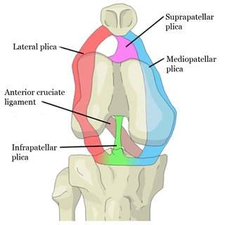 Plica Syndrome: The Mediopatellar Plica Is The Most Common Plica. (medial plica closer to your body midline)