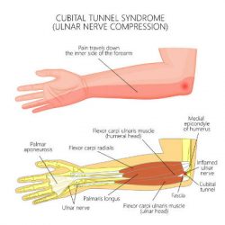 Diagnosis Of Cubital Tunnel Syndrome