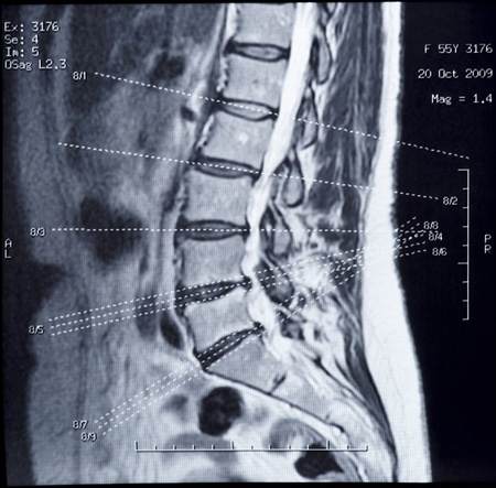 MRI Showing The Lower Back With Healthy Disc Near The Top With The Bottom Four Being Narrowed, Darker in Color With Disc Bulges: Degenerative Disc Disease: Downtown Toronto Chiropractic