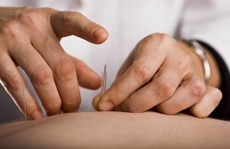 Acupuncture For Your Chronic Lower Back Pain: Painful Or Not? Helpful or Not? Toronto Downtown Chiropractor