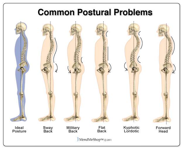 How to Improve Posture: Common Postural Problems Toronto Chiropractor Downtown