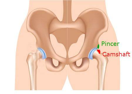 Cam and Pincer | Hip Impingement Syndrome: Why Do I Have Hip Pain: Downtown Toronto Chiropractor