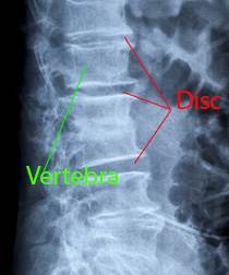 Degenerative Disc Disease Exercises: X-rays showing DDD: Downtown Toronto Chiropractic