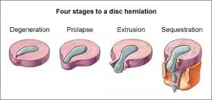 Disc Herniation Stages