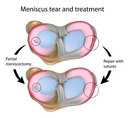 Knee Surgery Meniscectomy: Exercises For Derrick Rose After Knee Meniscus Surgery - Toronto Downtown Chiropractor