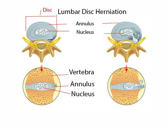 Lumbar Disc Herniation Vertebral Foramen - Spinal Stenosis Comprehensive Guide: 5 Exercises For Your Spinal Stenosis & Lateral Stenosis: Toronto Downtown Chiropractor