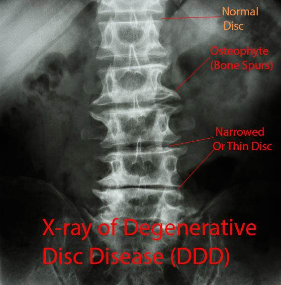 X-ray of Degnerative Disc Disease DDD: Osteophytes, Narrowed (Thin) Disc: Downtown Toronto Chiropractic