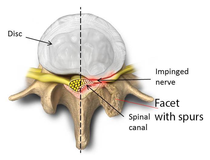 Facet Osteoarthritis-Spinal Stenosis Comprehensive Guide: 5 Exercises For Your Spinal Stenosis & Lateral Stenosis: Toronto Downtown Chiropractor