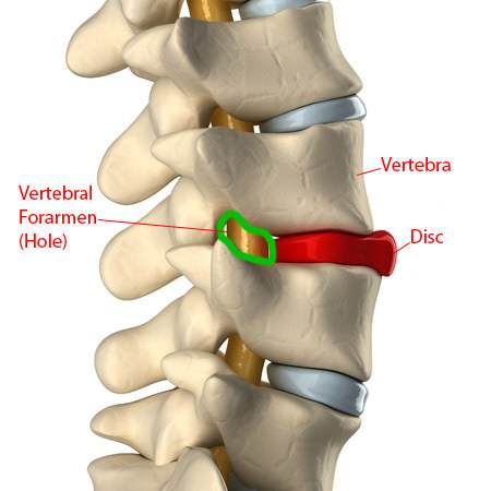 Vertebral Foramen - Spinal Stenosis Comprehensive Guide: 5 Exercises For Your Spinal Stenosis & Lateral Stenosis: Toronto Downtown Chiropractor
