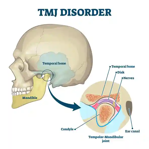 TMJ chiropractor shows picture of TMJ disorder displaying the bone, disk and nerves.